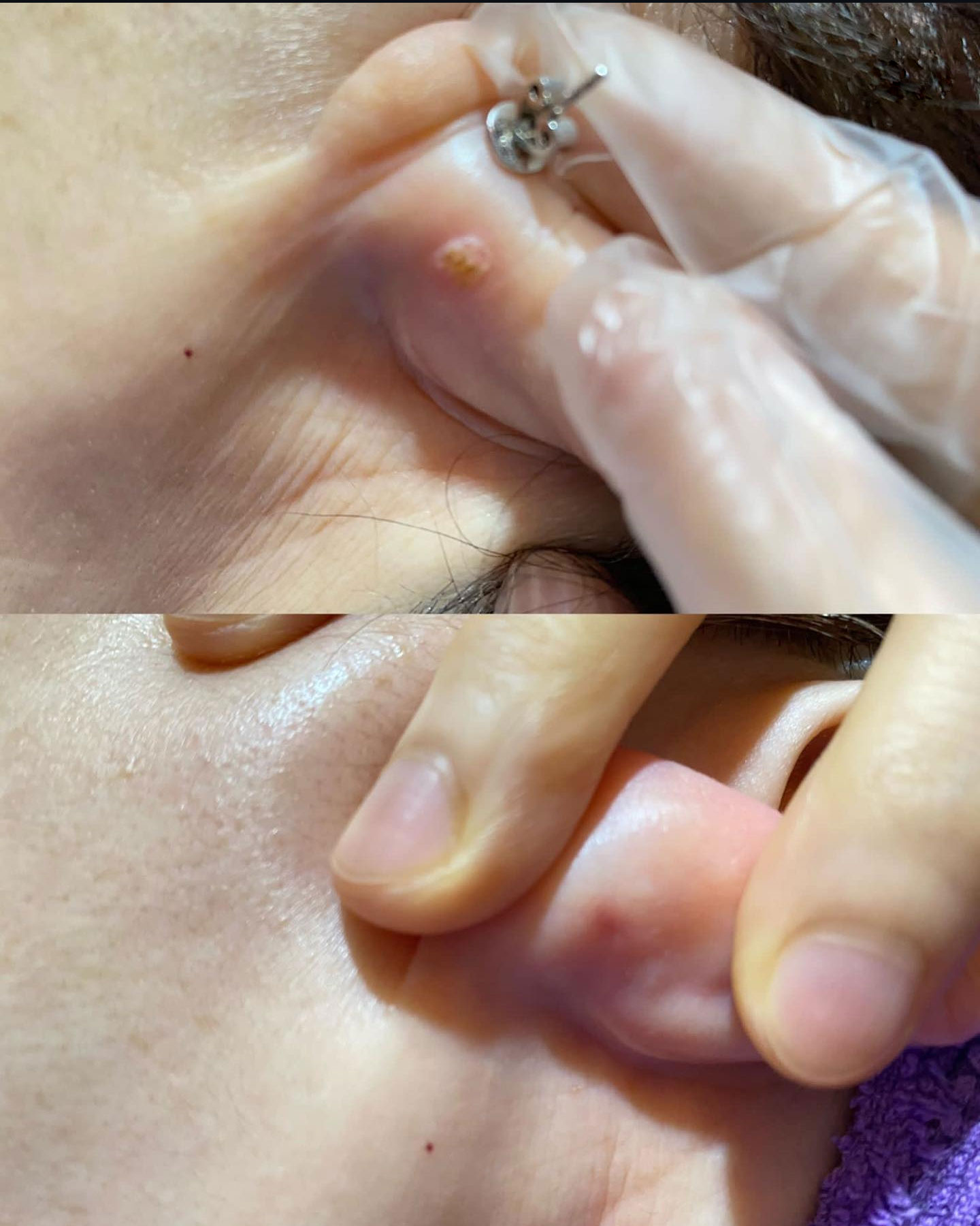 美之家美容中心服務-無痛脫墨